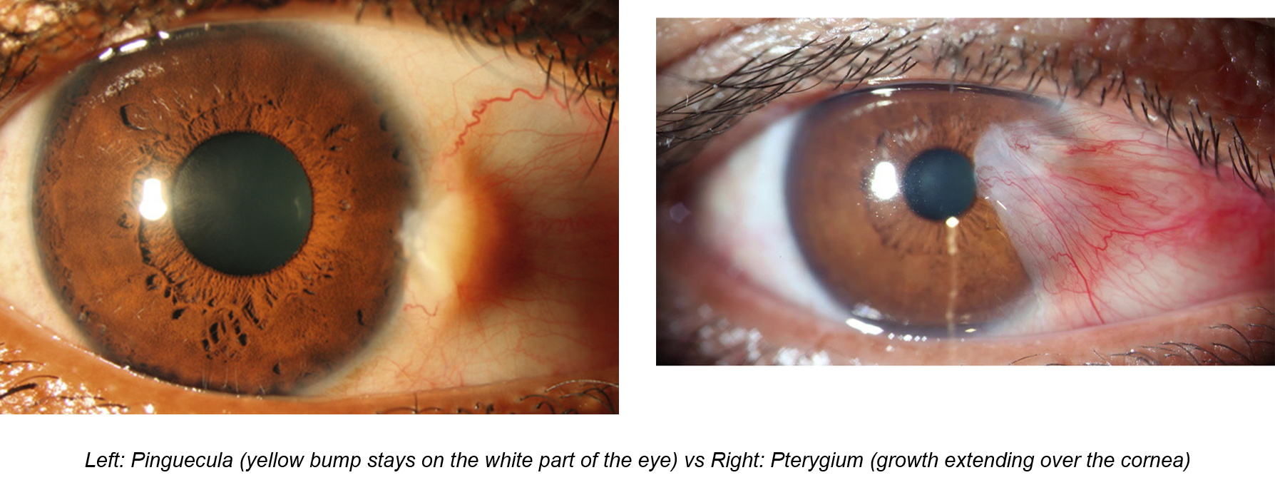 photo - pterygium webpage